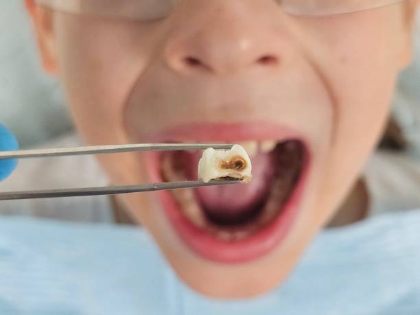 Best Emergency Broken Tooth Repair in Kokomo, IN